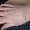 Yes, red spider mites do bite humans. 1