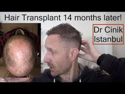 HAIR TRANSPLANT in TURKEY