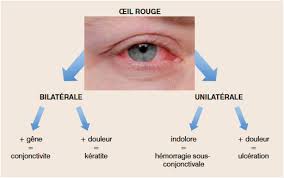 Vous vous êtes rétabli d'un problème à l'épaule et vous souhaitez éviter une récidive? Sport Et Pathologies Oculaires Savoir Les Reconnaitre
