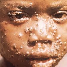 Monkeypox Represents Critical Public Health Challenge