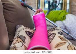 broken leg high res stock images shutterstock