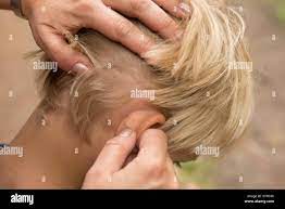 TREATMENT FOR SUCKING LICE - child little blond boy hair with lice Stock  Photo - Alamy