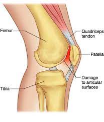 Bracing for Patellofemoral Pain Syndrome | Kintec