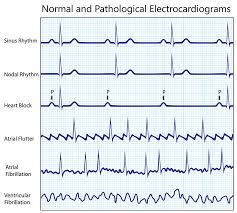 Ekg Ecg Interpretation Course Ceufast Nursing Continuing Education