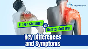 Image result for Frozen Shoulder