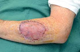 Post Op Wound Healing Care Dr Stretch