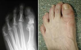 Soreness or tenderness when touched. Bunion Surgery Orthoinfo Aaos