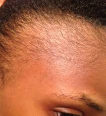 These are corticosteroid injections in the scalp or oral steroids like prednisone. Would Cortisone Injections Be An Option For My Hair Loss Or Is Hair Transplant Surgery The Only Option Photos