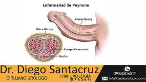 Check spelling or type a new query. Enfermedad Peyronie Quito Especialista En Peyronie Ecuador Urologos Especializados En Prostata Quito Hiperplasia Prostatica Benigna Incontinencia Urinaria Infecciones De Las Vias Urinarias Litiasis Urinaria Disfuncion Erectil Enfermedad De