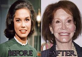 Mary Tyler Moore Botched Plastic Surgery Photos Bad Celebrity Plastic Surgery Bad Plastic Surgeries Celebrity Plastic Surgery