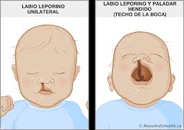 Un bebe con paladar hendido suele tener problemas para succionar la leche del pecho de la mamá, es por eso que alimentar a un bebe con palada hendido nos tomara mas tiempo de lo normal. Labio Leporino Y Paladar Hendido