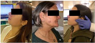 Effect of dry needling, ischemic compression and cross-taping of the  masseter in patients with orofacial myofascial pain: a randomized  comparative study