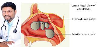 If the polyps grow large enough then they can begin to cause some unwelcome symptoms. Gulftimes What You Need To Know About Nasal Polyps