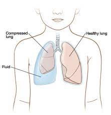 When Your Child Has Pleural Effusion | Saint Luke's Health System