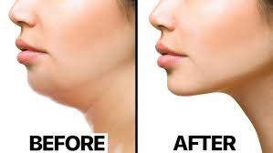 Ready to get rid of that double chin? We've got just the treatment!