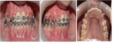 The mean surgical time for open eruption technique was lesser when compared with closed eruption technique (p = 0.000). Tads Assist Forced Eruption Of Upper Labially Impacted Canine Case Report