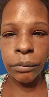 How do I treat copper tunnel ?