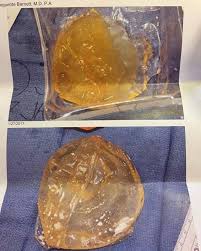 Pin On Breast Implant Illness