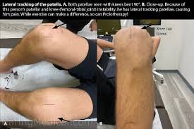 Image result for Patella Tracking Assessment