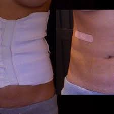 After liposuction, you can expect to be in recovery an average of 8 weeks however it is sometimes compression garments after liposuction. Compression Garment Concerns After Lipo