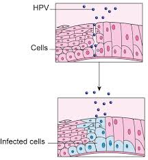 Cervical cancer is preventable with the hpv vaccine. Hpv And Cervical Cancer Jo S Cervical Cancer Trust