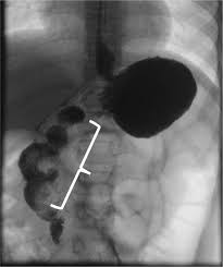 Image result for Midgut Volvulus