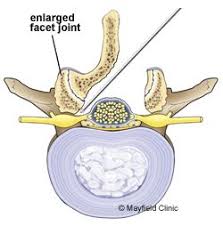 Pin On Spinal Fusion