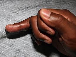 Jersey finger occurs when there is a strong contraction of the fdp. Jersey Finger New York Ny Handsport Surgery Institute