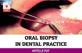 Dr.asif iqbal 2nd year p.g biopsy. Pdf Oral Biopsy In Dental Practice