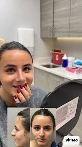 Rhinoplasty First Look After Surgery