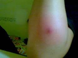 Carbuncle adalah kumpulan bisul yang berkembang dalam kelompok folikel rambut di bawah kulit. Penyebab Bisul Tanpa Mata Obat Bisul Tak Bermata