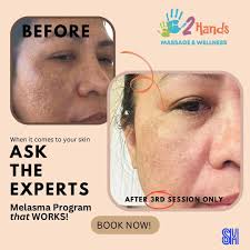 Say goodbye to dark spots and uneven skin tone with our specialized  𝗠𝗲𝗹𝗮𝘀𝗺𝗮 𝗧𝗿𝗲𝗮𝘁𝗺𝗲𝗻𝘁. At 2 Hands Massage and Wellness, we  offer advanced solutions to help you achieve a clearer, more radiant