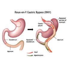 We did not find results for: Gastric Bypass Surgery For Weight Loss