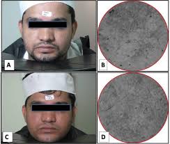 A comparative study of the efficacy of 2% Hydroquinone, 2% Kojic acid and  30% Glycolic peel in the treatment of Facial Melasma a