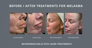 Image result for Melasma