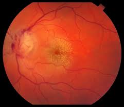 Image result for Ciliary Flush