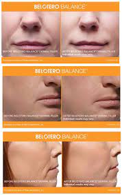Belotero Balance Before And After Photos Call Carolina Laser Cosmetic Center In Winston Salem Nc To Schedule Your Co Dermal Fillers Balance Winston Salem