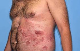 They may appear as reddish or purple scaly areas. Skin Cancer Types Cutaneous T Cell Lymphoma Signs Symptoms