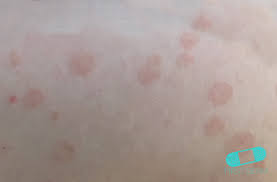 The cause of pityriasis rosea is not known, but it is commonly believed to be caused by a virus or bacteria. Pityriasis Rosea Online Dermatology