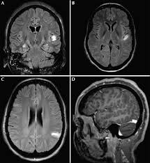 Image result for Brain Lesion
