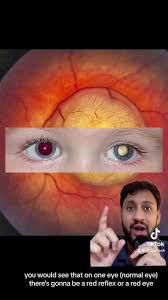 Image result for Red Reflex