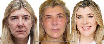 Lip Enhancement — Make Them More Attractive