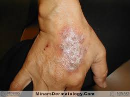 Image result for Hand Dermatitis