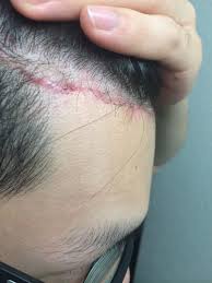However, other ingrown hairs may need to be removed, especially if it turns into an ingrown hair cyst. How Do I Deal With An Ingrown Hair At The Incision Site After Hairline Lowering Similar To Facelift Photos