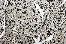 Das ist das neue ebay. Charcot Marie Tooth Disease Wikipedia