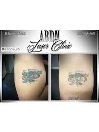 See reviews, photos, directions, phone numbers and more for the best tattoo removal in aberdeen, md. Tattoo Removal In Aberdeenshire Check Prices Reviews
