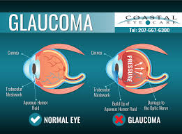 Image result for Glaucoma