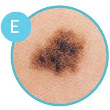 This is done in the operating room by a. Top 5 Skin Cancer Symptoms U S Dermatology Partners Blog