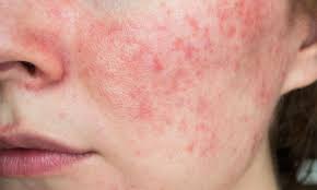 Image result for acne face