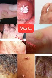 Image result for human papillomavirus symptoms